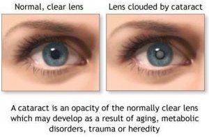cataract-picture-c-300x240-300x240