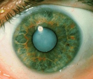 cataract1-300x254