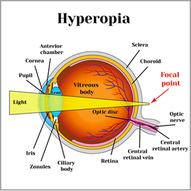 hyperopia