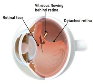 retinal-detachment-picture-400x360